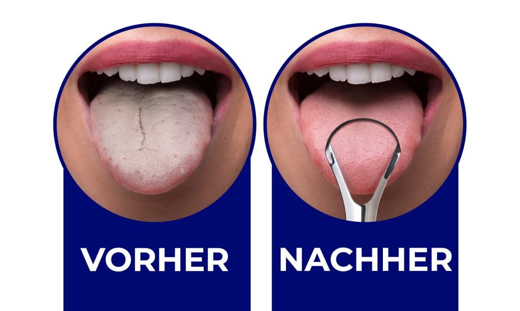Vor und nach der Verwendung eines Zungenschabers