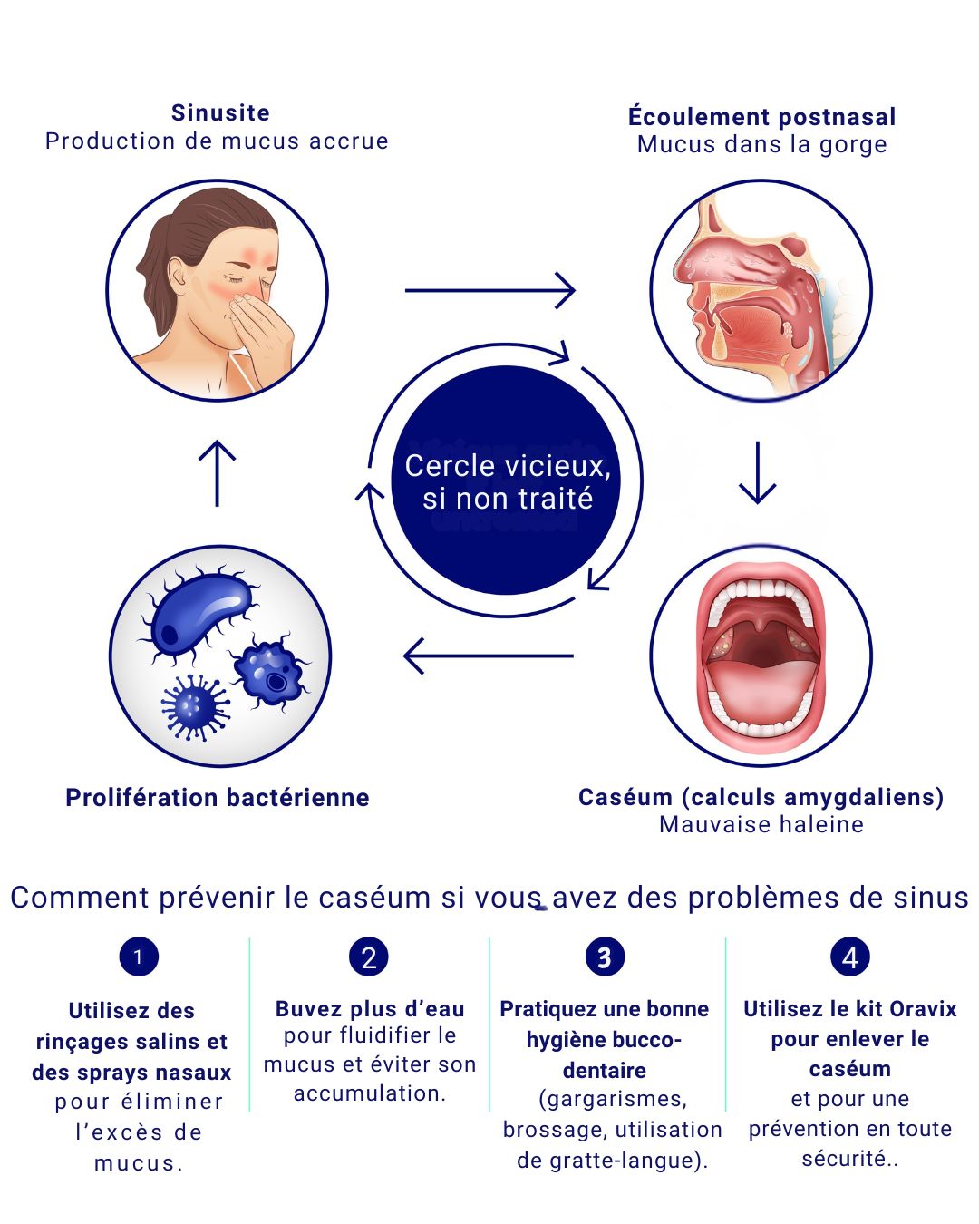 Schéma montrant le lien entre sinusite et caséum. Une sinusite provoque un excès de mucus, qui s’écoule dans la gorge (écoulement post-nasal), recouvre les amygdales et favorise la formation de caséum (calculs amygdaliens) et de la mauvaise haleine. Le cercle vicieux inclut : infection des sinus → écoulement post-nasal → caséum et mauvaise haleine → prolifération bactérienne → nouvelle sinusite. Le schéma propose aussi des conseils de prévention : utiliser des rinçages salins et sprays nasaux, boire plus d’eau, pratiquer une bonne hygiène buccale (gargarismes, brossage, utilisation de gratte-langue) et utiliser le kit Oravix pour retirer le caséum en toute sécurité.