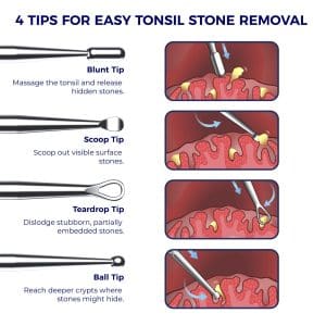 Oravix tonsil stone removal tool set