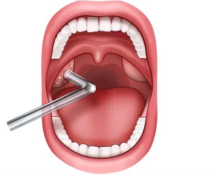 tonsil-stone-vacuum-pipe-on-tonsil