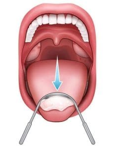 Tonsil Stone Remover Kit Tongue Scrapper