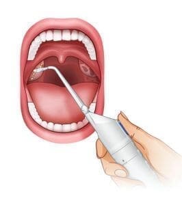 Tonsil Stones Water Flosser Water Flush