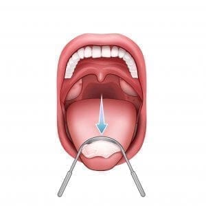 U tongue scrapper