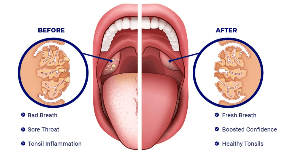 a-before-and-after-anatomical-comparison-between-tonsil-stones-tonsil-and-a-clear-tonsil