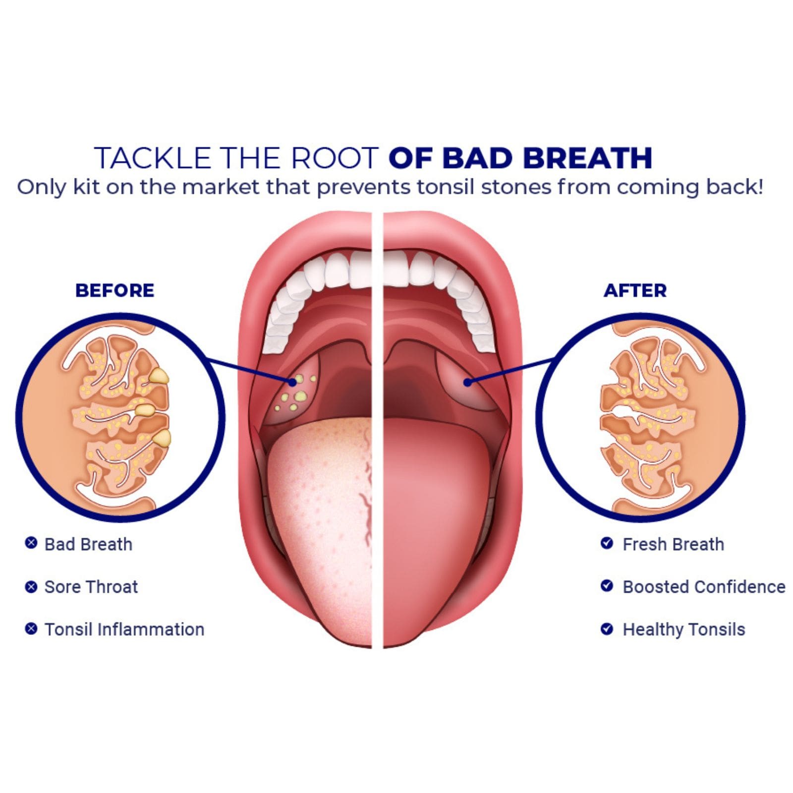 medical illustration of tonsil stones before and after throat view